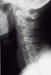 X-rays